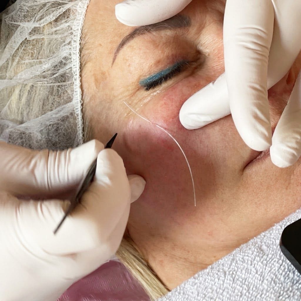 Collageen draadlift treatment