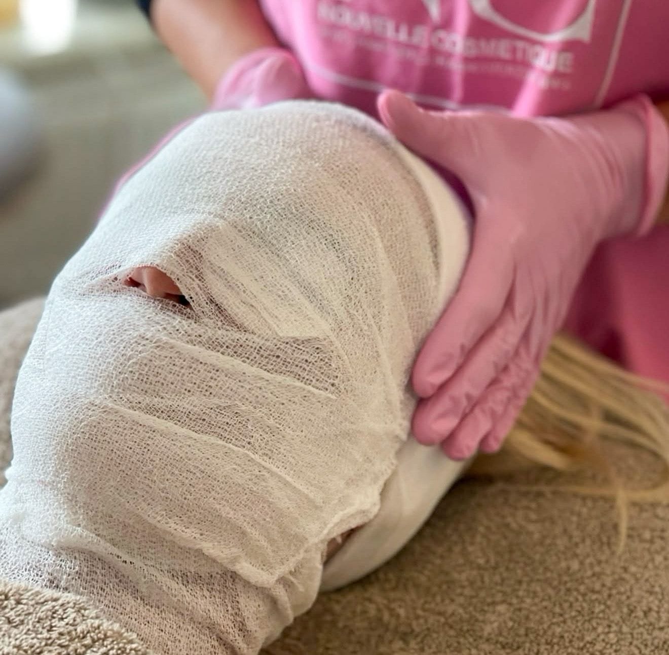 Carboxytherapie behandeling