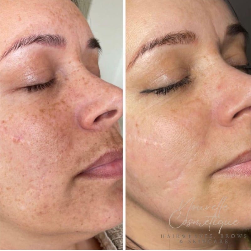 Peelings bij Nouvelle Cosmétique