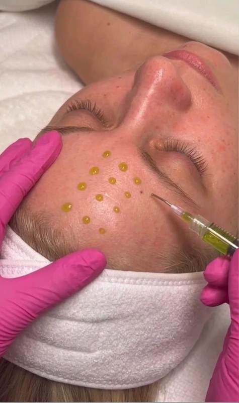 Toepassing van de Pfect-A Illumin-Peeling met een applicatiepen op het voorhoofd